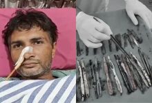 Surgeons remove 29 spoons, 19 toothbrushes, pens from patient’s stomach